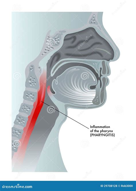 Viral Pharyngitis Causes Vector Infographic Template | CartoonDealer ...