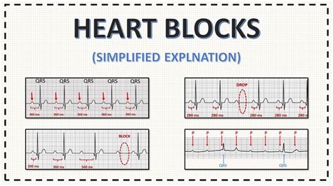 Types Of Heart Block With Ecg Pattern