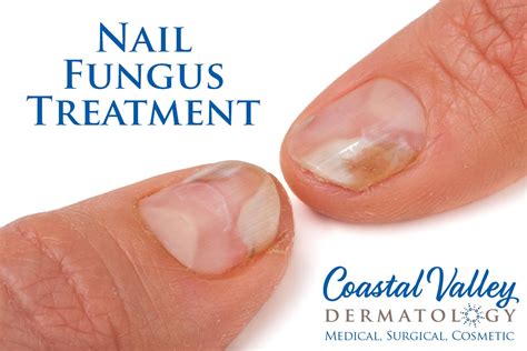 Nail Fungus - Coastal Valley Dermatology