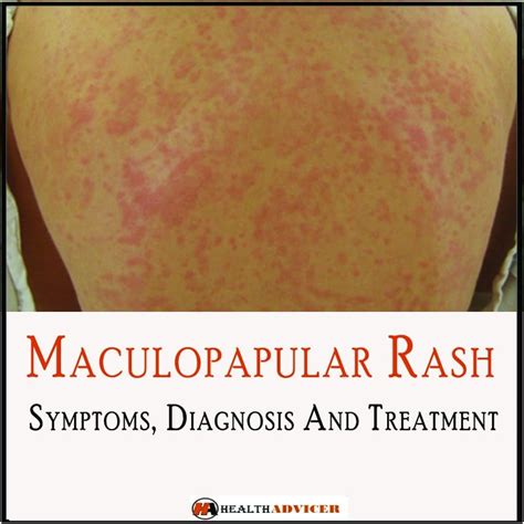 Maculopapular Rash: Causes, Symptoms And Treatment