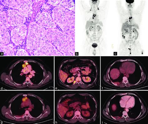 Biopsy from anterior mediastinal mass showed sheets of neoplastic ...