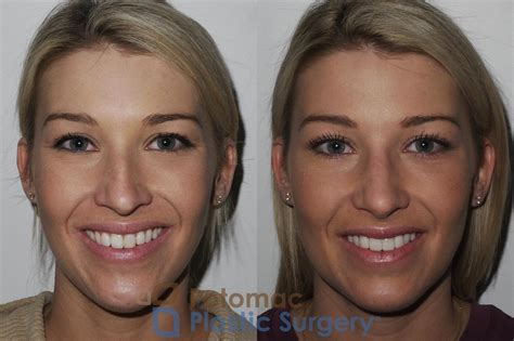 Rhinoplasty and sinus surgery to balance the shape and function of the ...