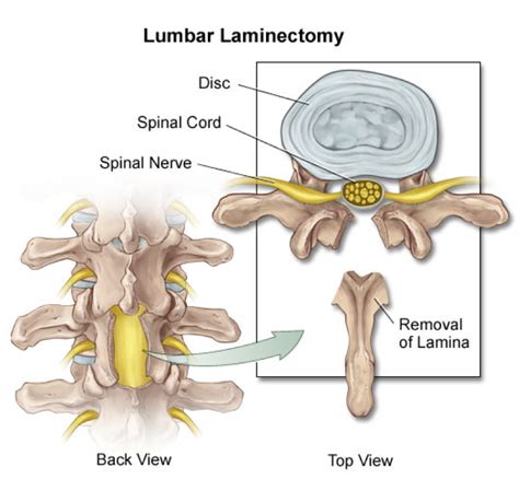 Laminectomy - ONZ Spine