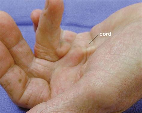 Dupuytren's Contracture: Causes, Symptoms, Diagnosis & Treatment » How ...