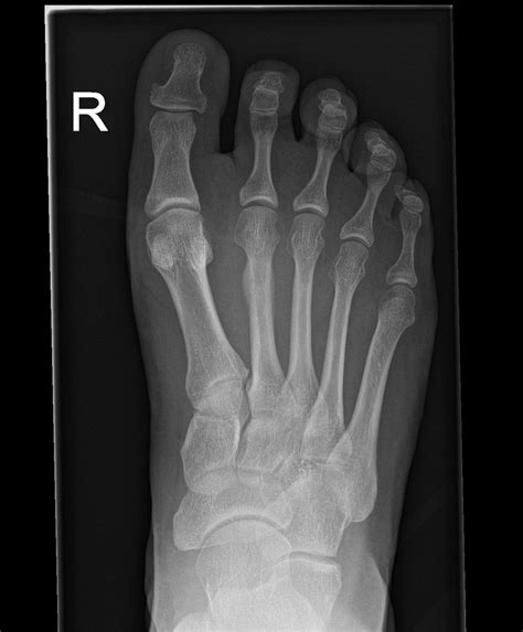 Xray Of Foot Stress Fracture