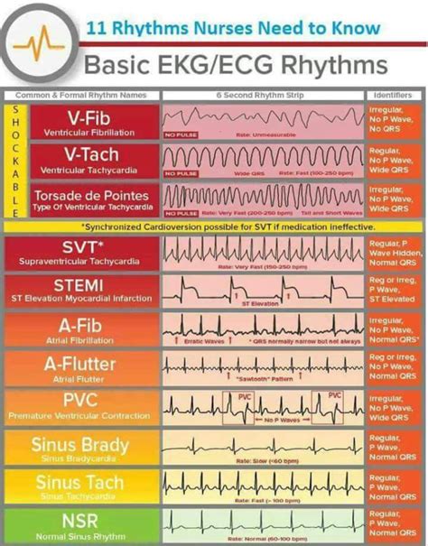 Basic Ecg rhythms - MEDizzy