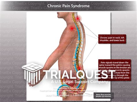 Chronic Pain Syndrome - TrialQuest Inc.