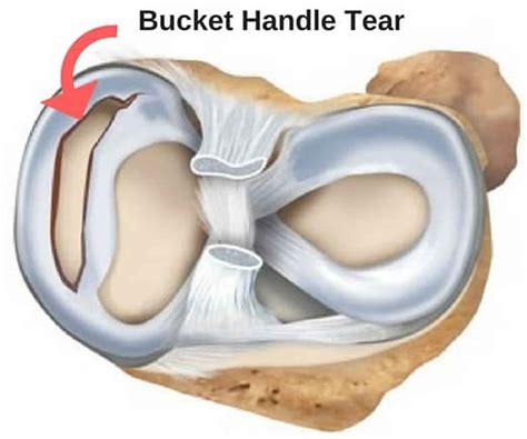 Torn Meniscus Diagram