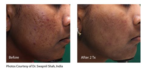 Mothlhtqqjbpqdp: Co2 Laser For Acne Scars Before And After