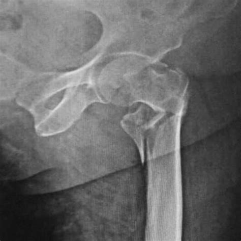 Recovery from a hip fracture varies widely among NHS hospitals, study finds