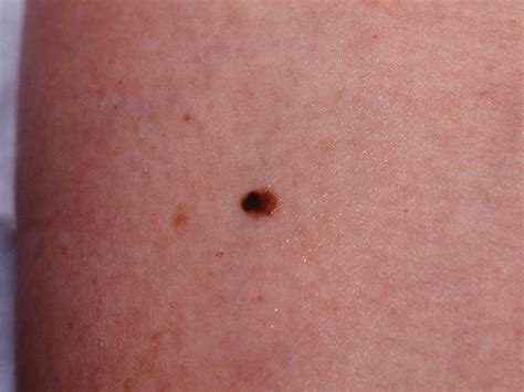 melanomas in situ - pictures, photos