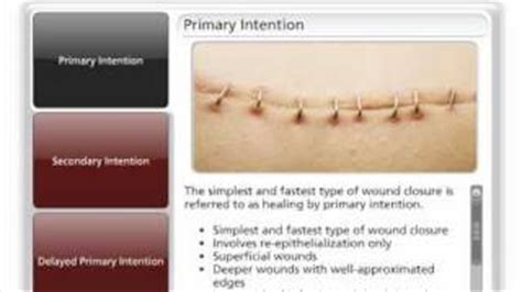 All comments on Types of Wound Closure - YouTube