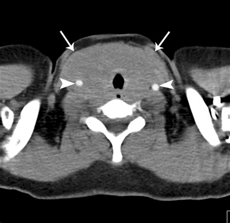 Riedel Thyroiditis Associated With Massive Neck Fibrosis - Ozbayrak ...