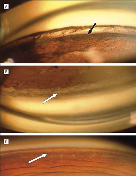 Early Predictors of Traumatic Glaucoma After Closed Globe Injury ...