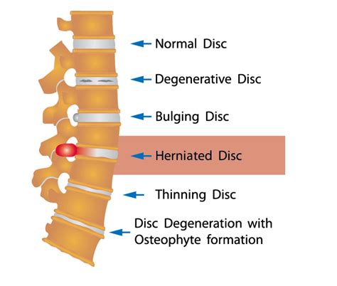 Herniated Disc