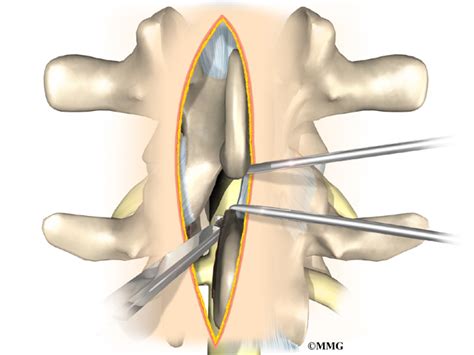 Lumbar Laminectomy | eOrthopod.com