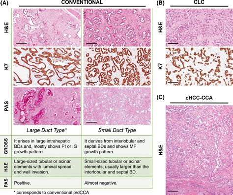 Cholangiocarcinoma Gross