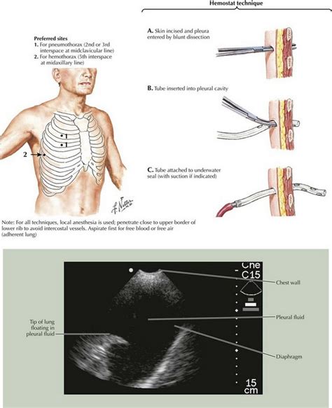 Chest Tube Placement | Basicmedical Key