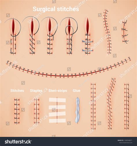 1,088 imágenes de Surgical staples - Imágenes, fotos y vectores de ...