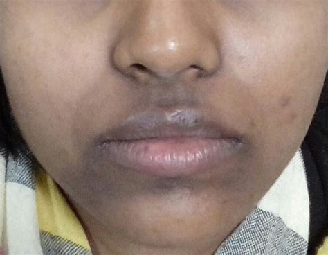 Hyperpigmentation Around The Mouth: Causes And Treatments | Justinboey