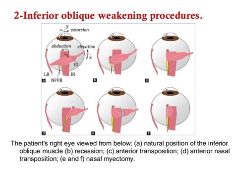 Superior oblique palsy