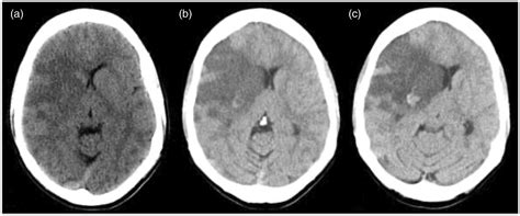 Malignant middle cerebral artery syndrome with thrombotic ...