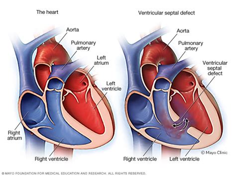 Ventricular septal defect - Mayo Clinic