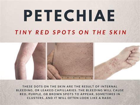 Tiny Red Spots on Skin (Petechiae): Causes and Treatments | Dots, Infos ...