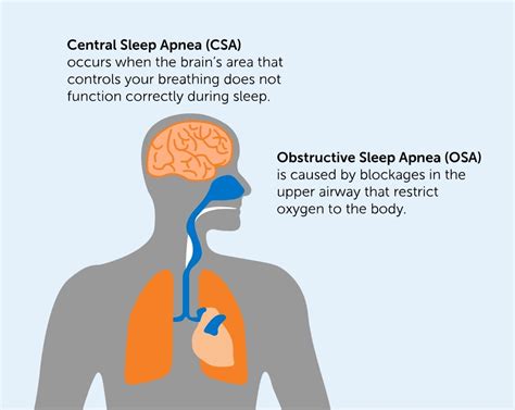 Central Sleep Apnea (CSA) | remedē® System