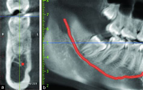 Tomographic mapping of buccal shelf area for optimum placement of bone ...