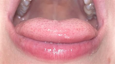 Syphilis tongue? : r/obgyn