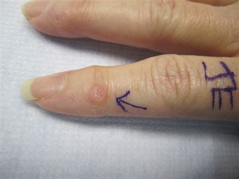 Photos of Mucous Cysts in Fingers - John Erickson, MD