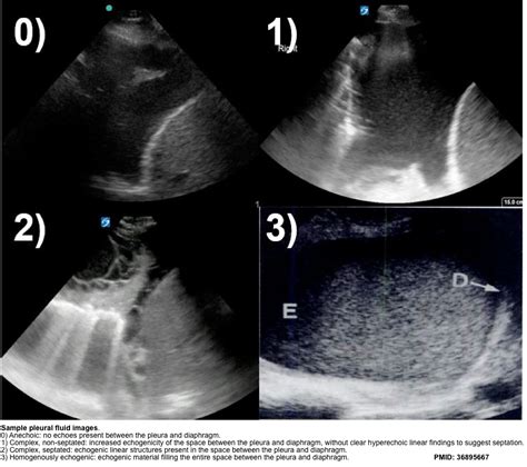 Ascites Vs Pleural Effusion Ultrasound