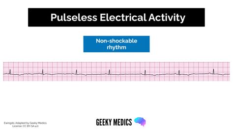 Shockable vs. Non-shockable Rhythms in Cardiac Arrest | Geeky Medics