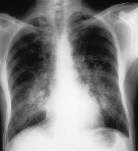 Diffuse Alveolar Hemorrhage - Pulmonary Disorders - MSD Manual ...