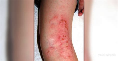 Nummular eczema symptoms | General center | SteadyHealth.com