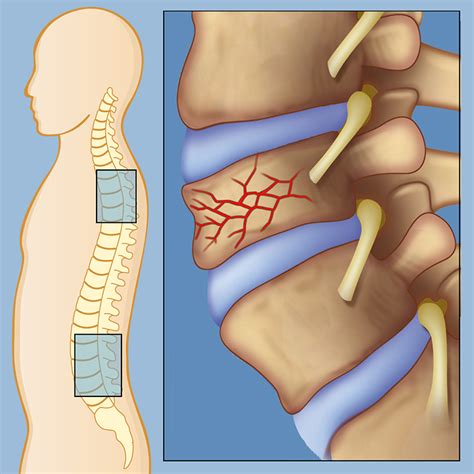 Spinal Fracture Causes, Symptoms & Treatments