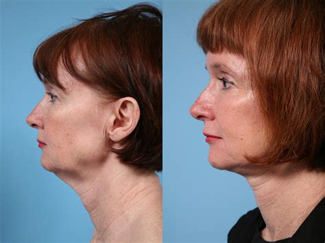 Neck Lift Before & After Photos Patient 145 | Chicago, IL | TLKM ...