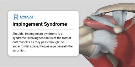 Impingement Syndrome - NJ's Top Orthopedic Spine & Pain Management Center