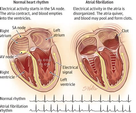 Atrial Fibrillation | Atrial Fibrillation | JAMA | The JAMA Network