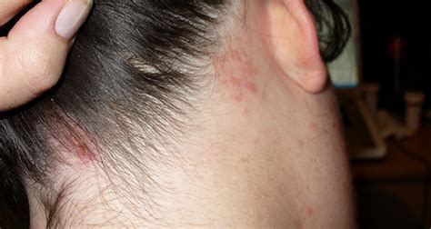 When is shingles contagious?