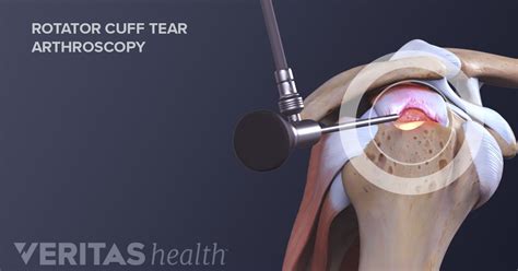 Rotator Cuff Tear Surgery