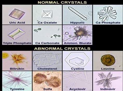 Types of Crystals in Urine