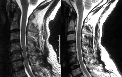 Abnormal Cervical Spine Mri