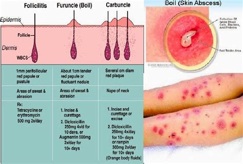 ShiJie Is Unstoppable: Follicalitis (Skin Rash)