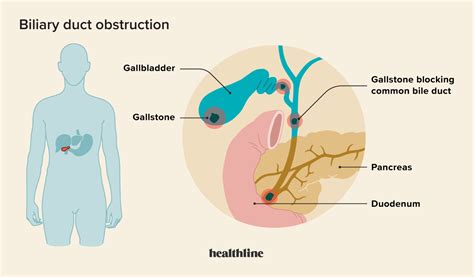 Bile Duct Obstruction: Symptoms, Treatment, and Causes