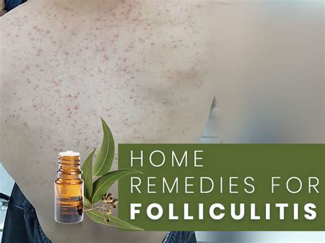 Folliculitis Leg Mild