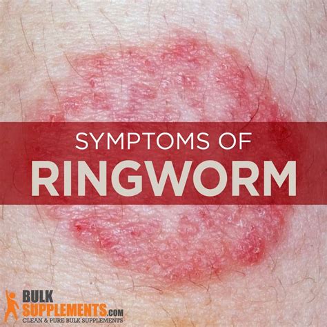 Ringworm Look Like