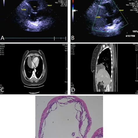 Anterior mediastinal mass (thymoma) in a 30-year-old woman. A and B TTE ...