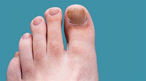 15 home remedies for toenail fungus – Cooking AMOUR